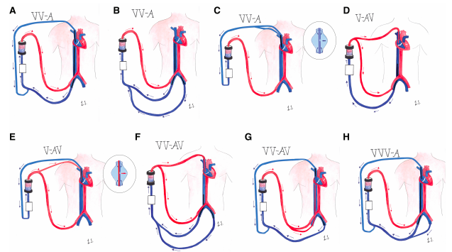 Boutique Models of ECMO