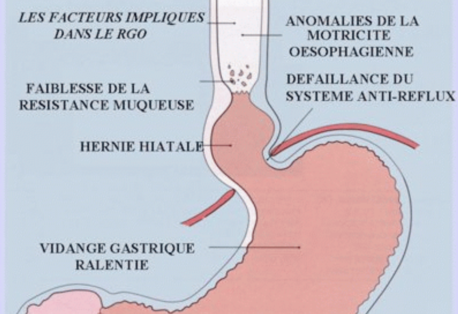 Hernie hiatale: De deux types =>